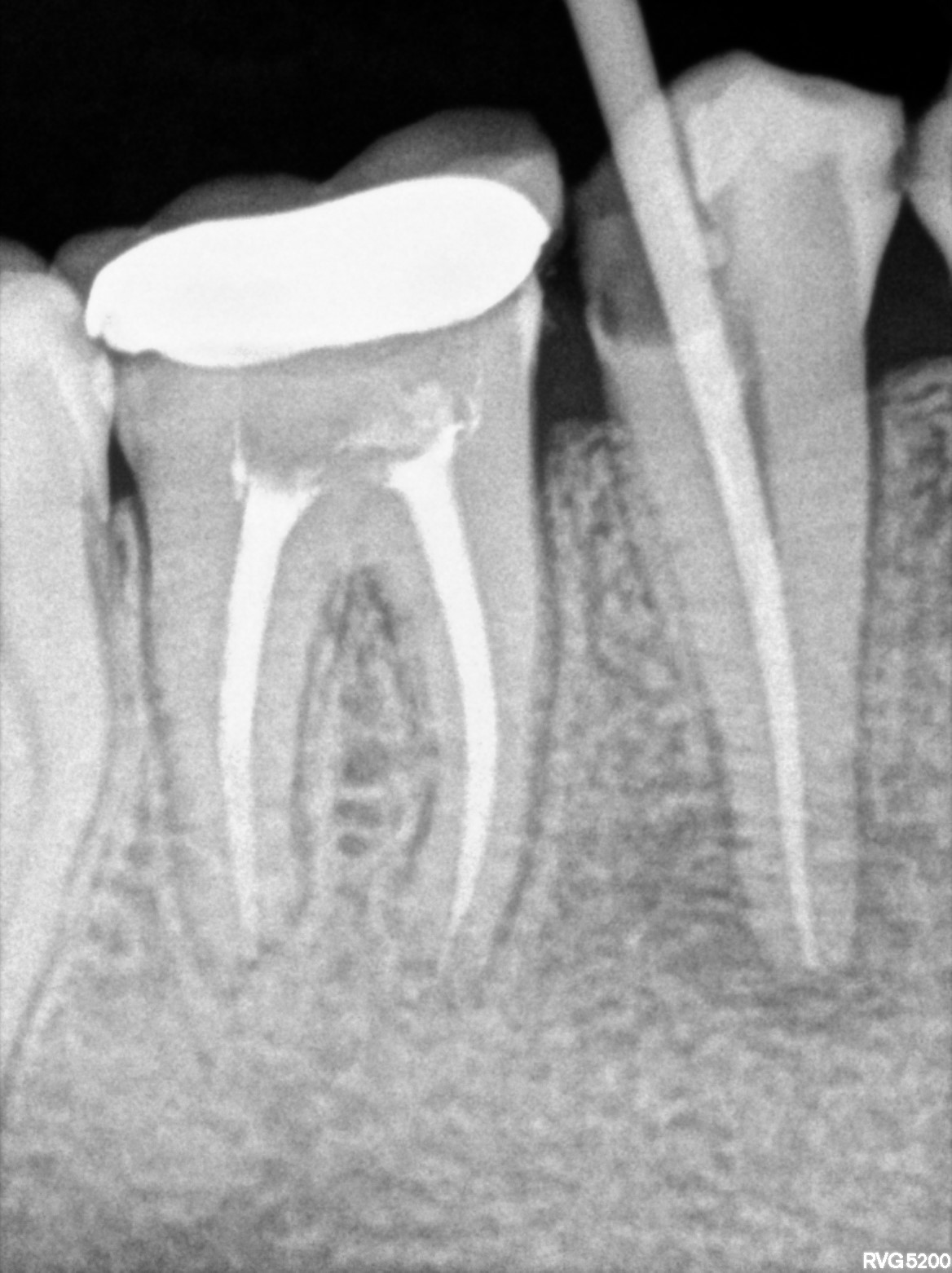 Dental X-ray
